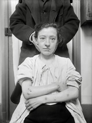 . Charles Lhermitte  [1881-1945] Folles de la Salpêtrière Négatifs au gélatino-bromure  d’argent sur verre Vers 1910 Collection du musée  Nicéphore Niépce